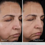 Obagi ELASTIderm Advanced filler koncentratas, 20 ml